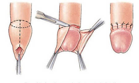 Những thắc mắc về việc cắt bao quy đầu
