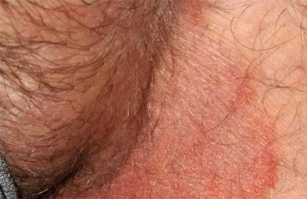 Bệnh Chàm Bìu