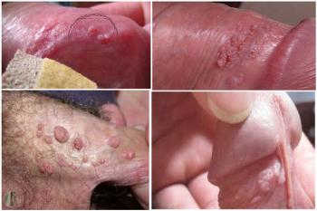 Biểu hiện sùi mào gà ở nam giới