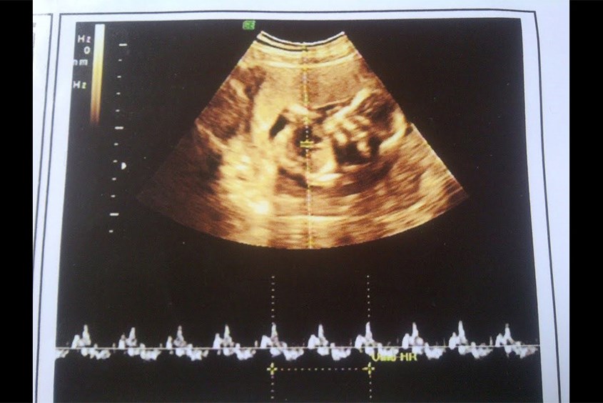 Thai nhỏ dưới 7 tuần tuổi